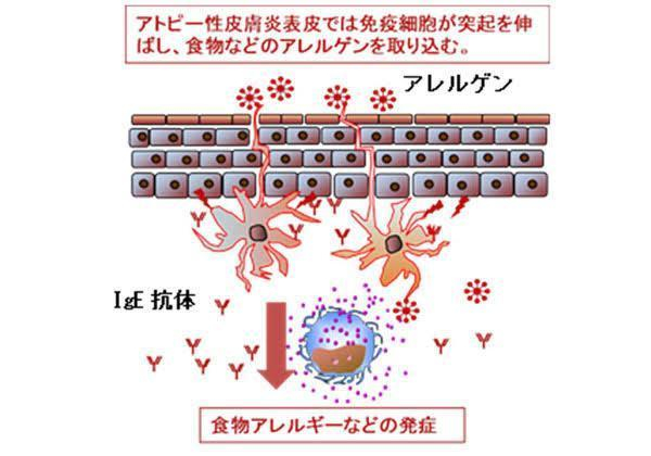 【アトピーは大人になってからでも発症する？】