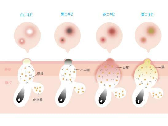 【ニキビの種類と原因】