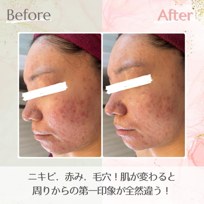 【ハーブピーリングBeforeAfter】