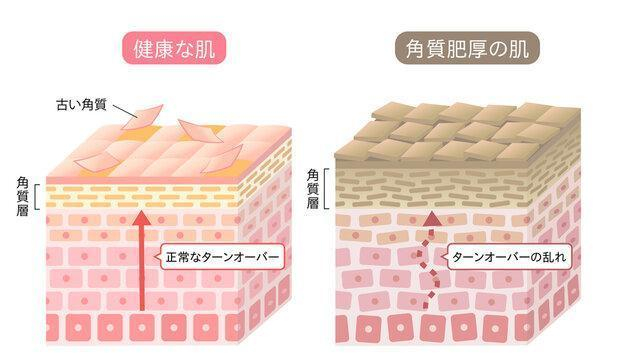 ニキビ肌には【陶肌トリートメント】