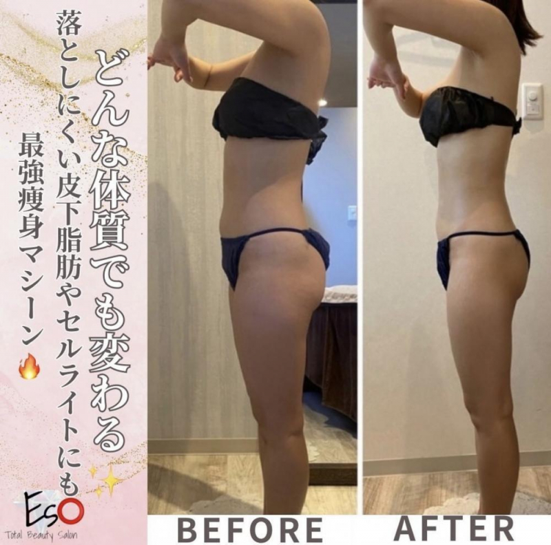 セルライト解消にぴったり【フォースカッター】
