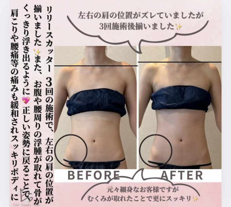 数回の施術で変わる！【リリースカッター】
