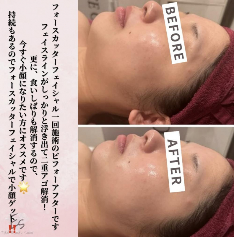 その日で小顔に【フォースカッターフェイシャル】