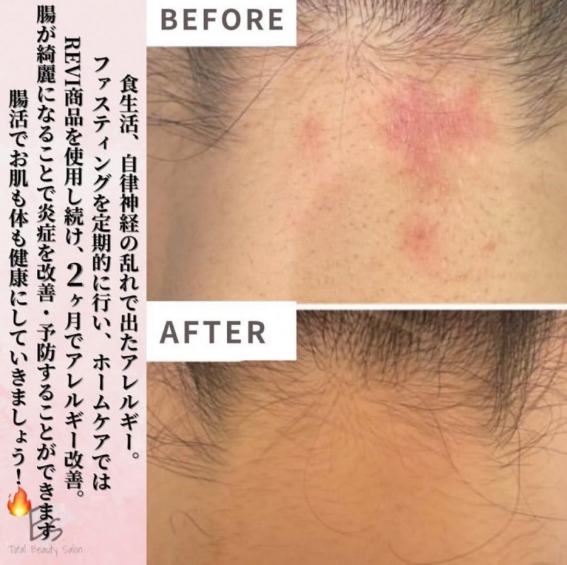 アレルギー改善に【ファスティング】