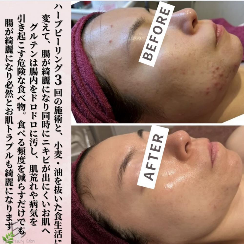 腸美人は超美人！【ハーブピーリング】