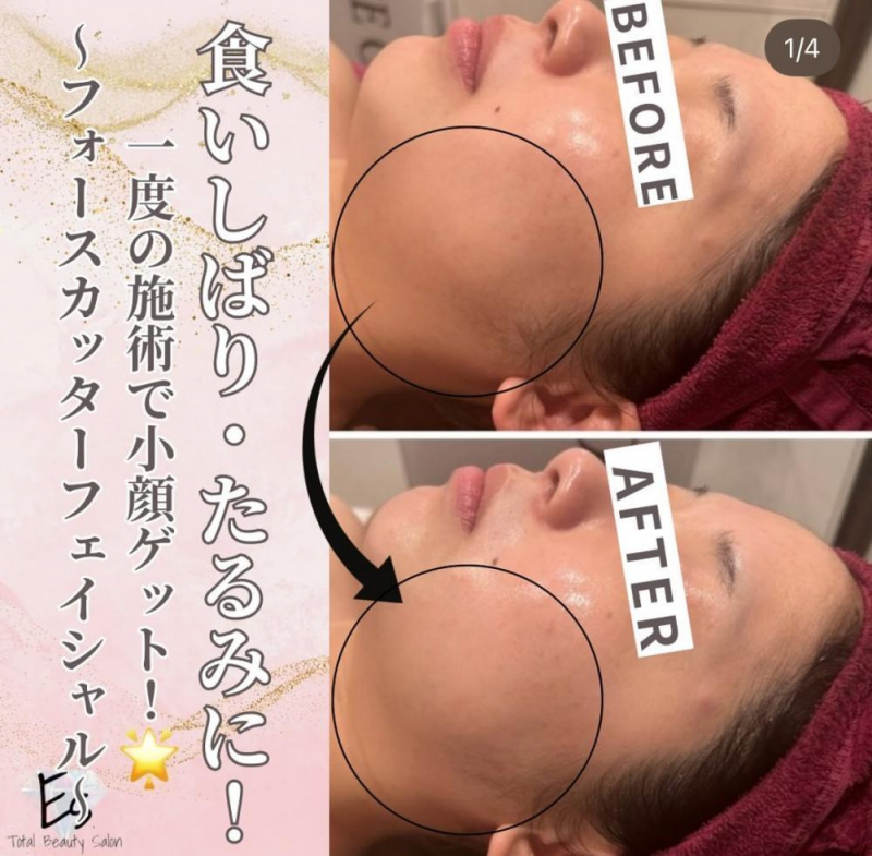 【フォースカッターフェイシャル】