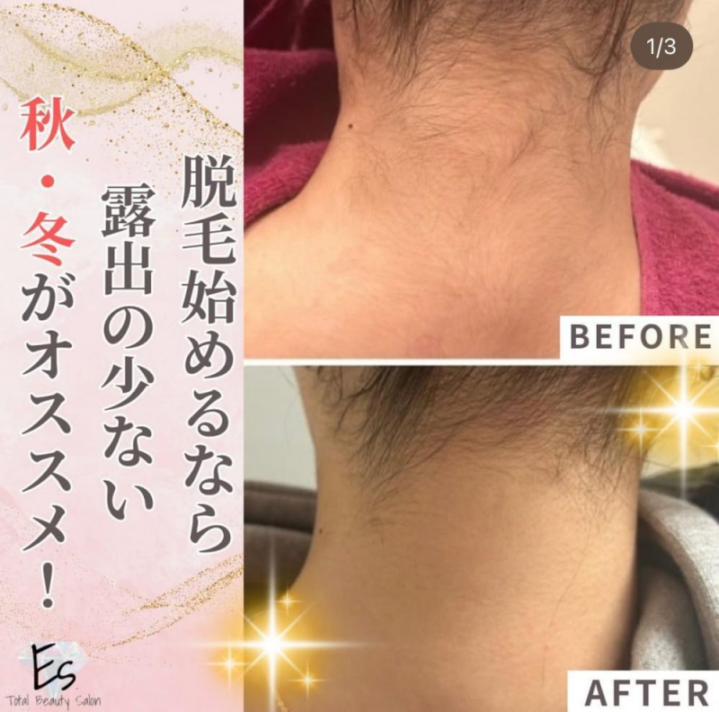 最短6ヶ月で脱毛卒業【SHR脱毛】